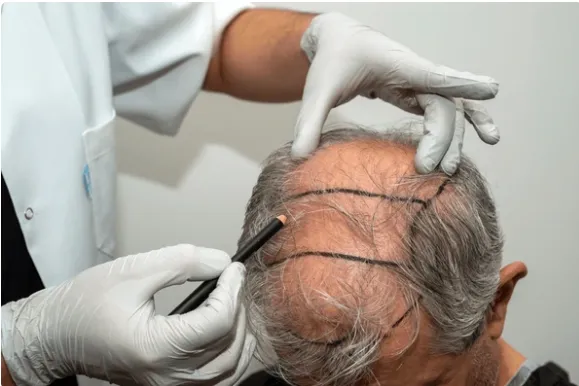 Cirugía capilar en Málaga Restauración segura y natural del cabello